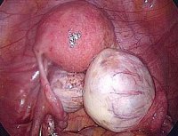 Эндометриоз яичников