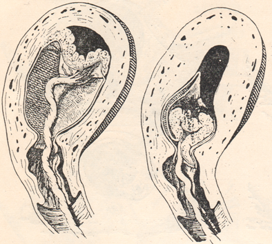 В первом случае между центральной частью плаценты и стенкой матки накаплива...