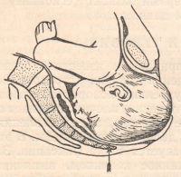 Основные моменты механизма рождения головки