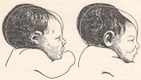Влияние механизма родов на форму головки; головная (родовая) опухоль; кефалогематома